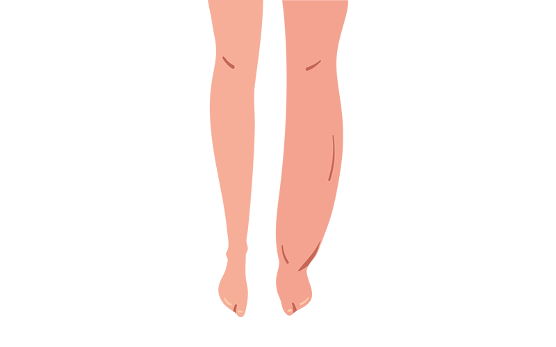 Legs with moderate swelling, visible on the lower legs and ankles. Legs with moderate swelling, visible on the lower legs and ankles.